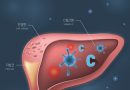 C형간염 검사, 평생 한 번은 꼭 받아야 하는 이유는?