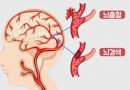 뇌졸중에 대한 오류와 진실