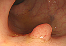 대장암의 씨앗 “용종”